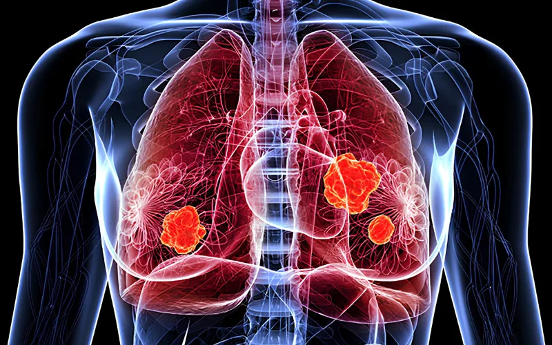 Lung cancer treatment in Varanasi